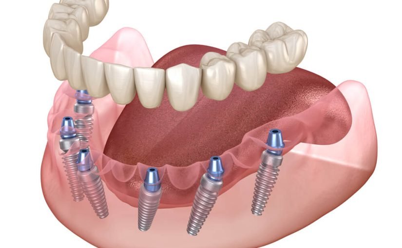 השתלות שיניים ממוחשבות